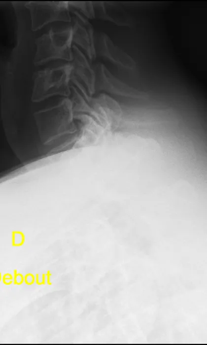 A side-view x-ray of the cervical spine showing the stacked neck vertebrae, taken after the accident