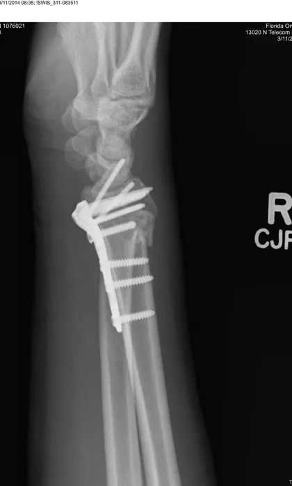 An x-ray of a wrist repaired with a surgical plate and screws after the accident